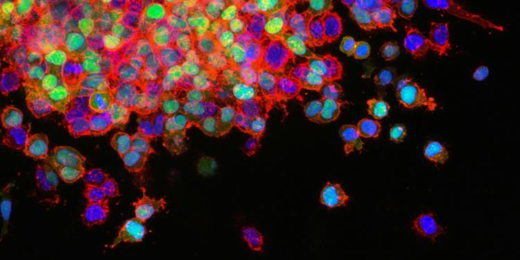 Photo by NCI Lung Cancer Metastasis