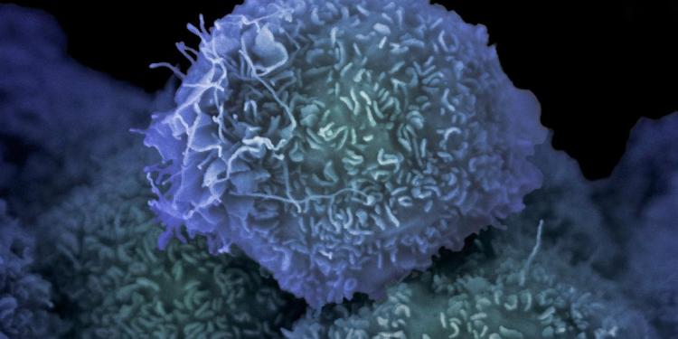 Pancreatic cancer cell captured with scanning electron microscope