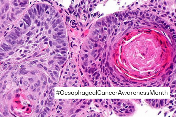 Oseophageal cancer piece
