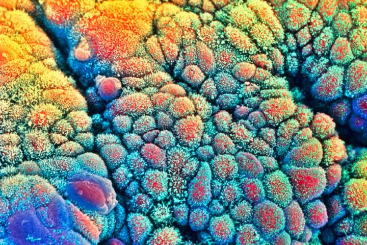 A scanning electron micrograph of cancer cells in the intestine  STEVE GSCHMEISSNER/SCIENCE PHOTO LIBRARY