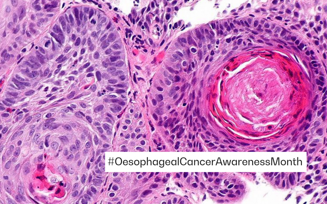 Oseophageal cancer piece