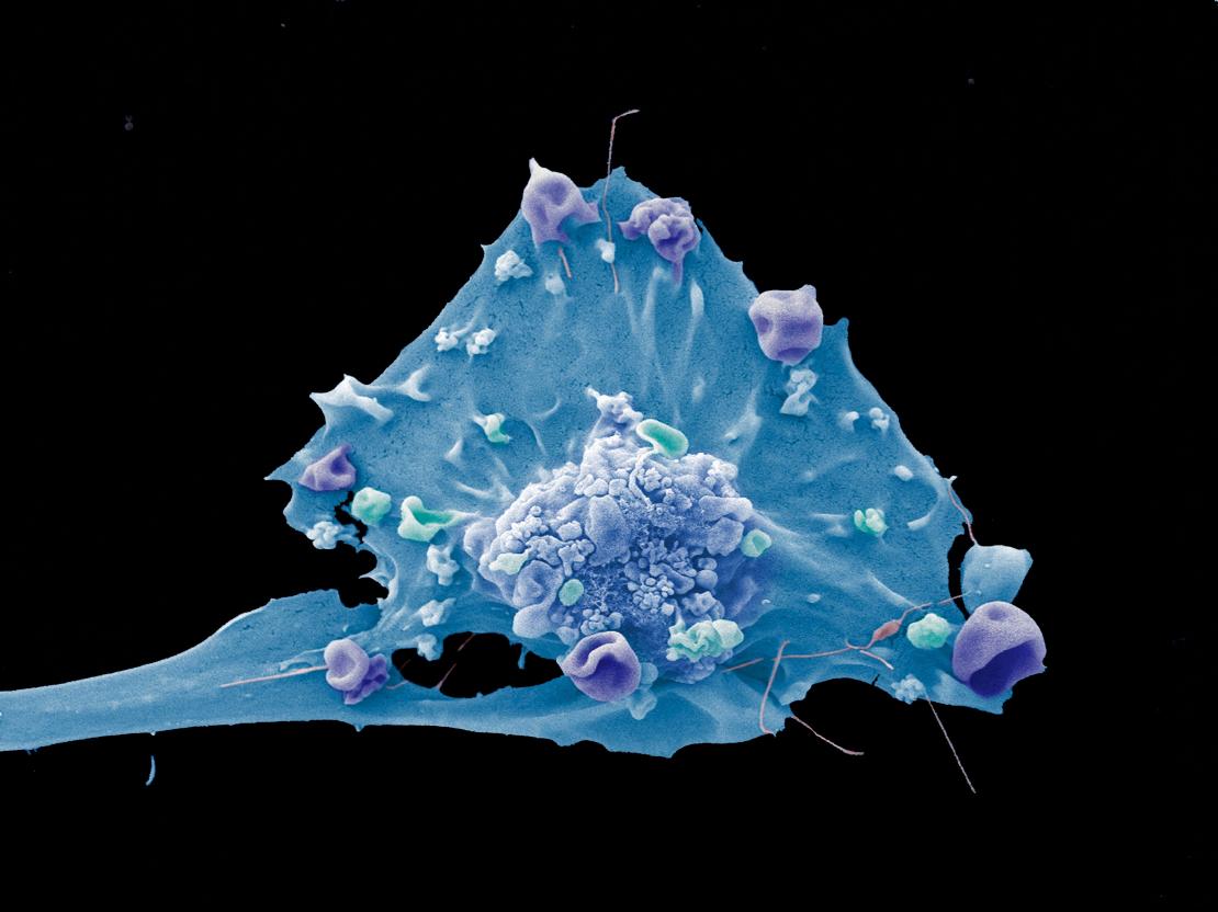 Colour-enhanced microscopy image of a breast cancer cell.